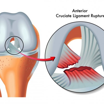 Ligament and Other Joint Injuries